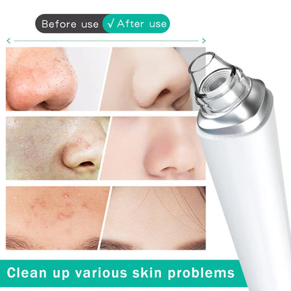 Gleime™ - Blackhead Pro Vacuum Device